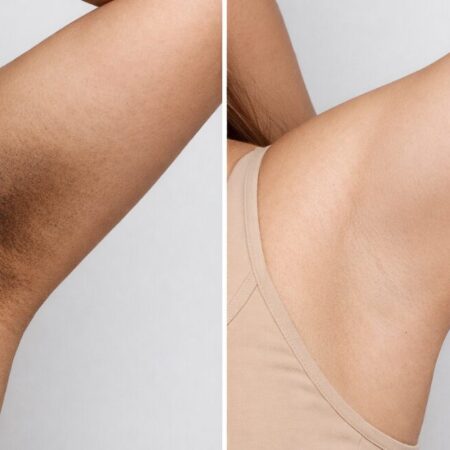 Manchas de Virilha e Axilas: Clariei em 45 Dias Com Ingredientes Caseiros