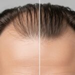 O Que Realmente Funciona Para Parar a Queda de Cabelo? Guia Completo 2026